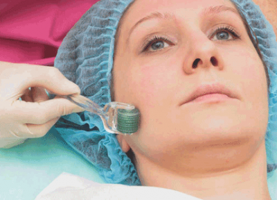 میکرونیدلینگ چیست؟ با این روش زیبایی پوست آشنا شوید