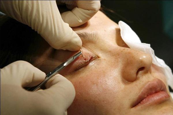 سیر تا پیاز عمل کاشت مژه طبیعی سیر تا پیاز عمل کاشت مژه طبیعی
