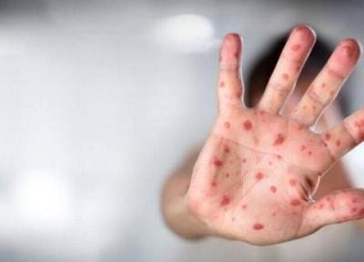 سازمان جهانی بهداشت هشدار داد، خطر آبله میمون در جهان جدی و واقعی