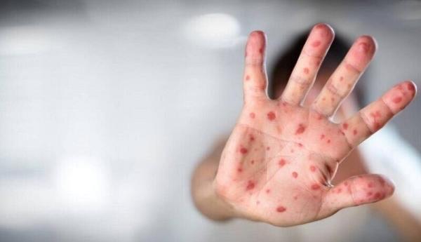 سازمان جهانی بهداشت هشدار داد، خطر آبله میمون در جهان جدی سازمان جهانی بهداشت هشدار داد، خطر آبله میمون در جهان جدی و واقعی