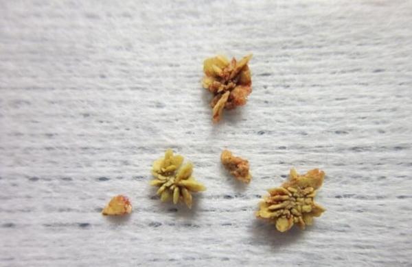بهترین نوشیدنی برای جلوگیری از ایجاد سنگ مثانه؛ چرا دچار برترین نوشیدنی برای جلوگیری از ایجاد سنگ مثانه؛ چرا دچار سنگ مثانه می شویم؟